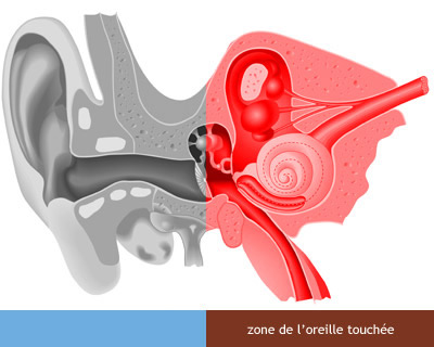 Problemes auditifs acouphène et bourdonnement